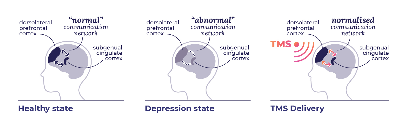 What Is Tms – Queensland Neurostimulation Centre